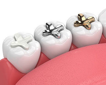 Three different types of dental restorations on teeth