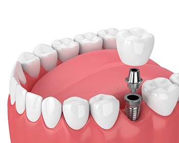 dental implants getting abutment before restoration