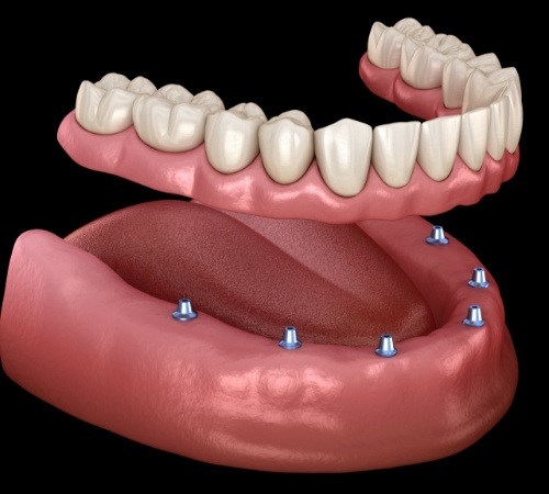 implant dentures in Lincoln