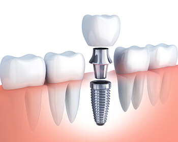 single dental implant in Lincoln