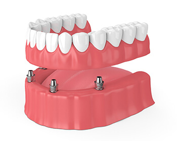 implant dentures in Lincoln