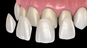 set of four veneers on front teeth