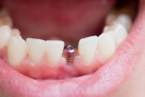 dental implant with natural teeth